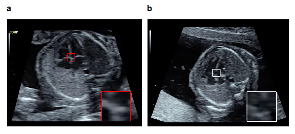 図1 物体検知技術を活用した胎児心室中隔の異常検知例