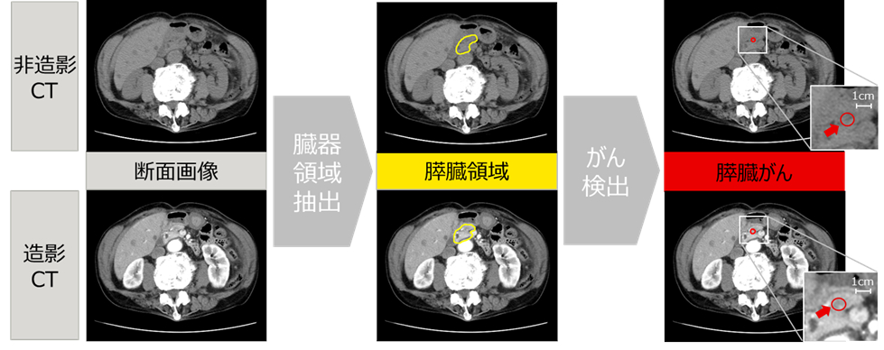 図1：開発する技術による膵臓がんの疑いがある部位の検出イメージ